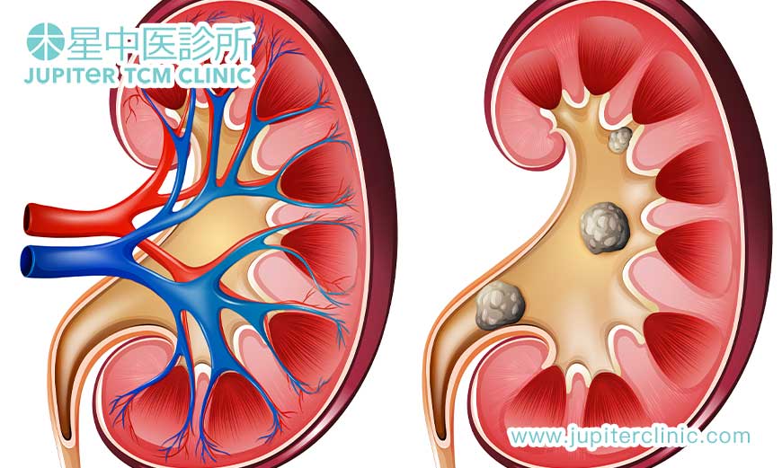 中藥治療腎結石：清熱利濕，化石排石